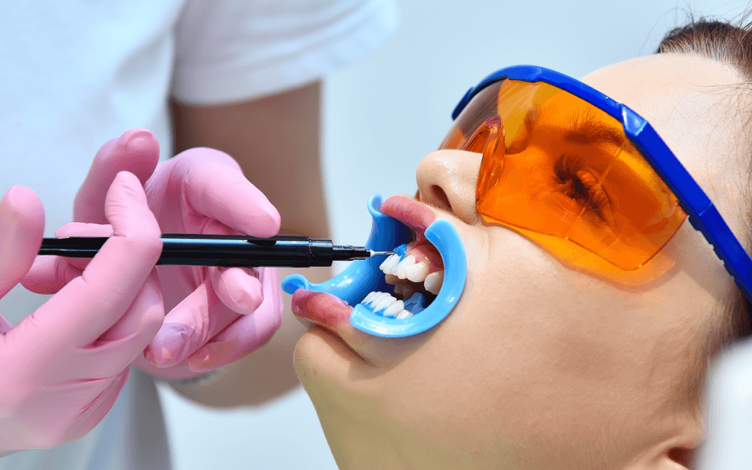 Limpieza dental o blanqueamiento ¿Son lo mismo?