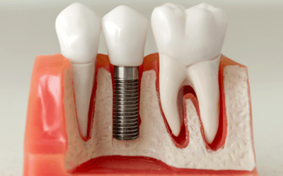 Prótesis Dentales: ¿Cuáles Existen y Cuál escoger?