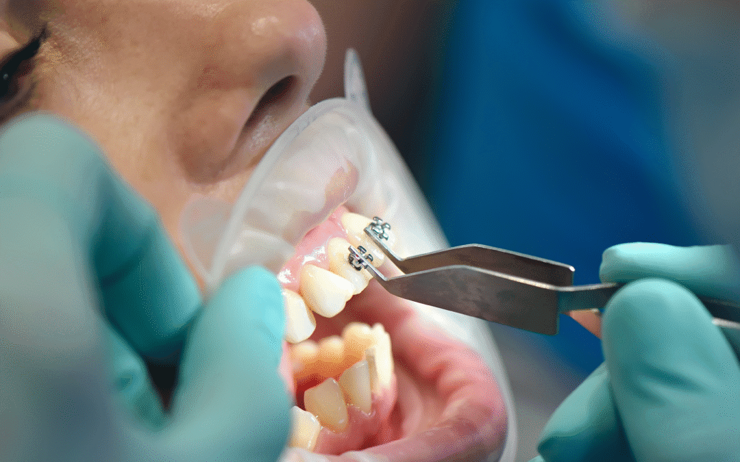 ¿Duele ponerse brackets? Todo lo que debes saber antes del primer día