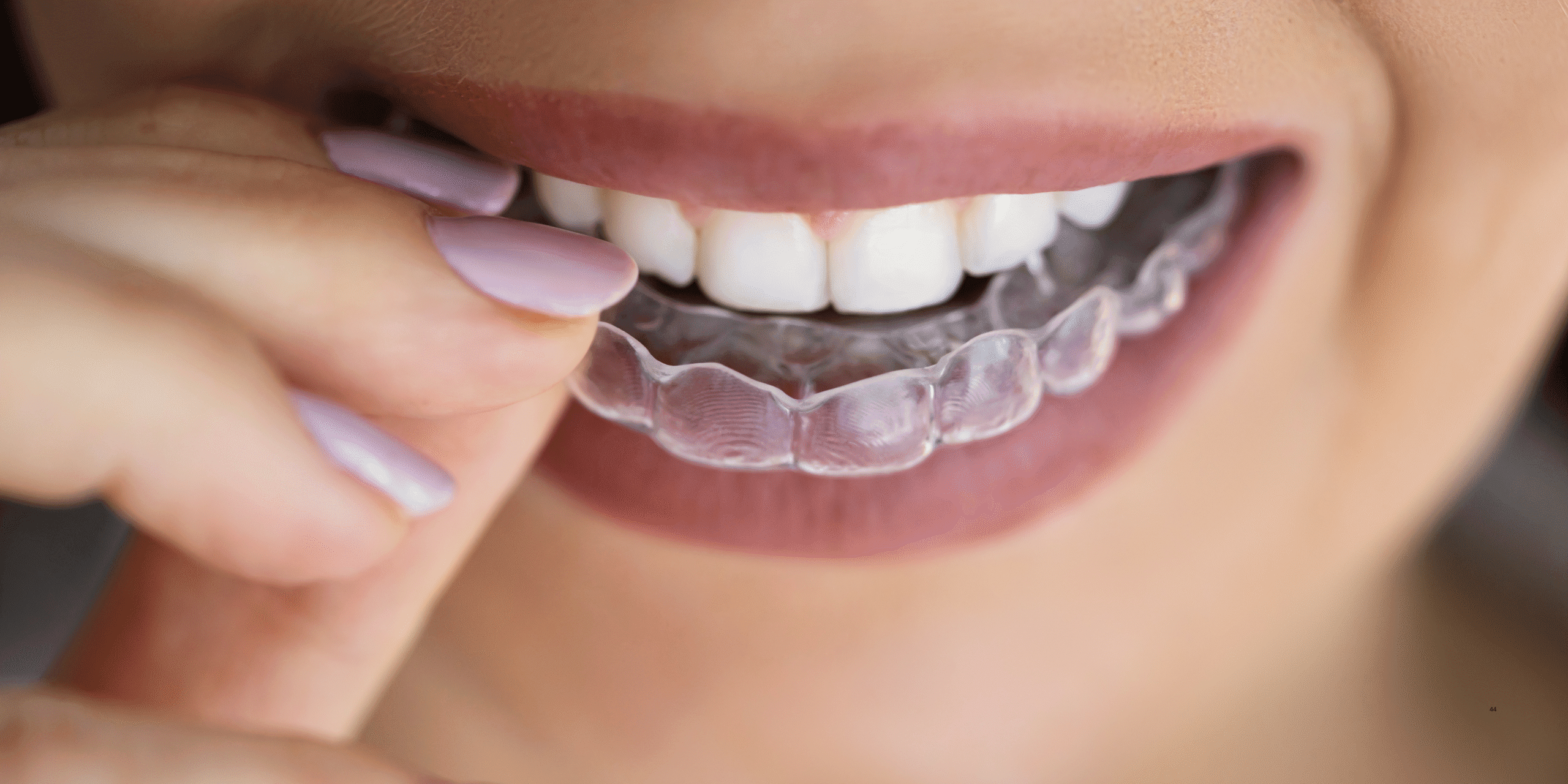 ¿Qué es una placa alineadora dental y cuándo se recomienda?